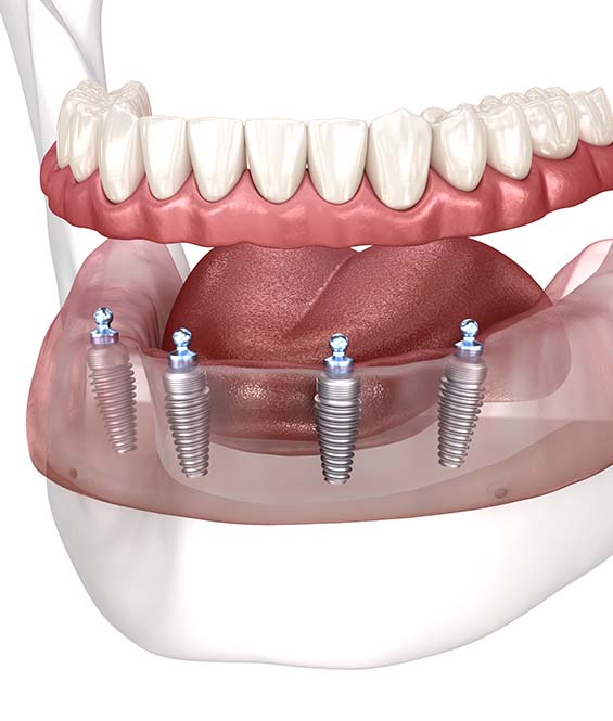 implant Denture in Langley 